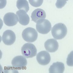 Double chromatin dot form Two chromatin dots (sometimes known as "signet ring" form.