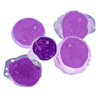 Population E blast cells