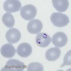 Multiple early trophozoites within a single erythrocyte, one having a double chromatin dot