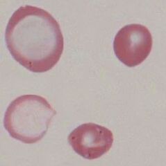 RC F anisocytosis G.jpg