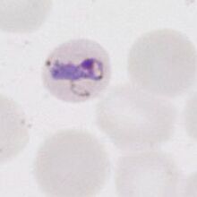 ormal or enlarged P.ovale (may become ovoid)
