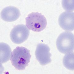 High parasitaemia Most of the typical early trophozoite P.falciparum forms are present