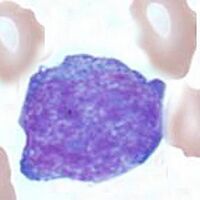 DLBCL.jpg