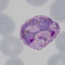 ormal or enlarged P.ovale (may become ovoid)