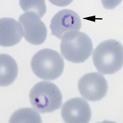 Double chromatin dot form Two chromatin dots (sometimes known as "signet ring" form).