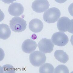 Delicate and small early trophozoite form of Plasmodium falciparum
